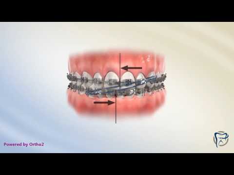 Vídeo: Els brackets realinen la mandíbula?