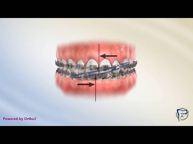 Elastics 101