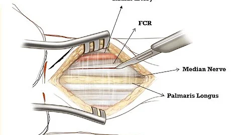Volar (Henry) Approach to the Wrist .