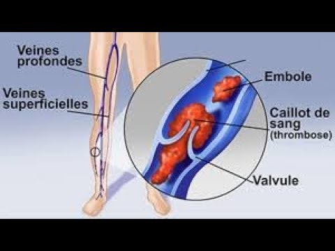 Vidéo: La Datation De L'organisation Du Thrombus En Cas D'embolie Pulmonaire: Une étude D'autopsie
