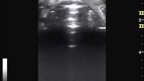 ultrasound doppler diffuse goiter and big superior thyroid a.