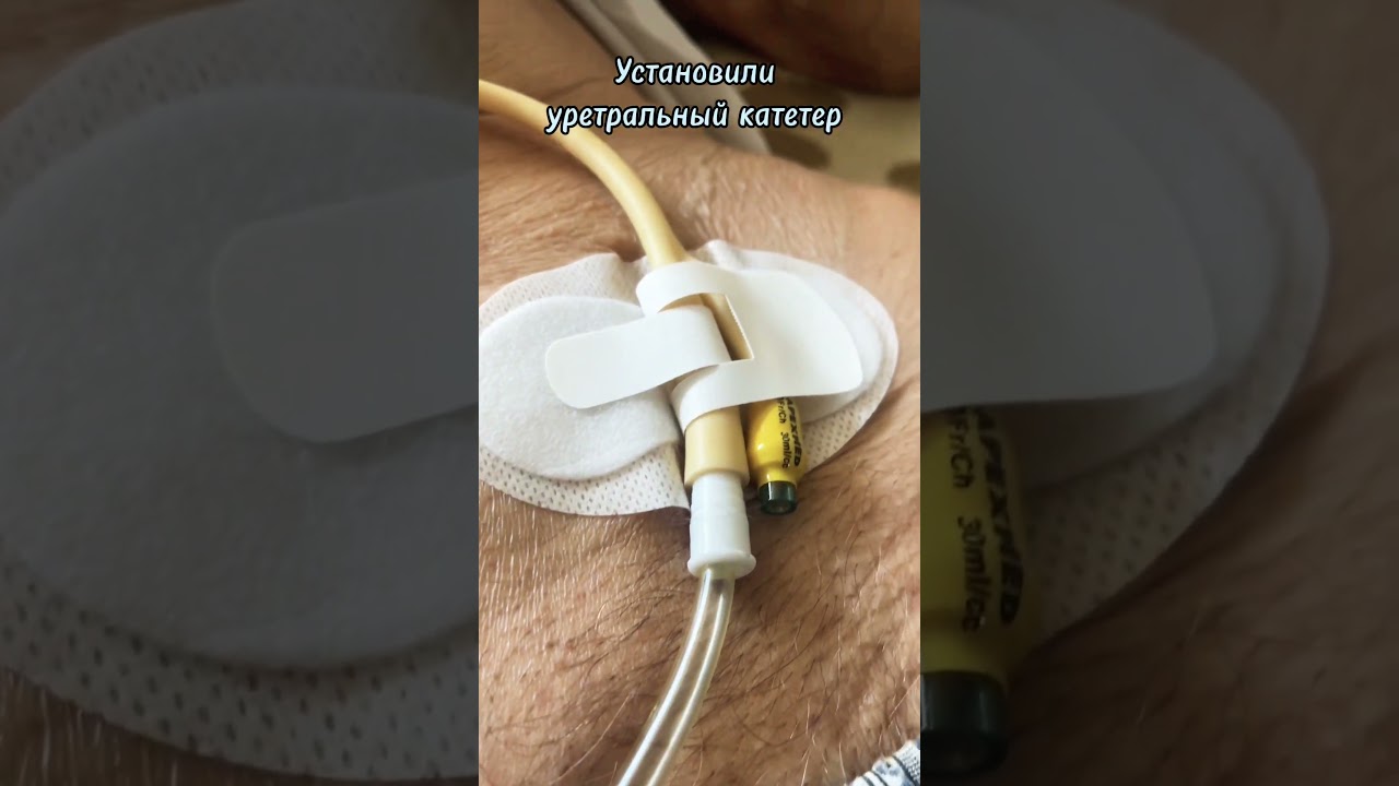 Установка катетера с УЗИ. Записали на плановую операцию 👨‍⚕️ #операция #мкб #катетер #уролог