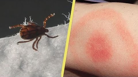 What bit me? Spot the difference between a spider, tick or mosquito bite -  Health and Weather