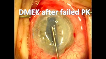 DMEK following a failed PK