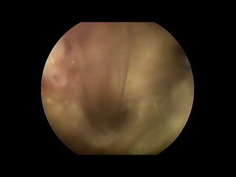 Fimbriated&necrotic bladder TCC/Переходно-клеточная карцинома мочевого пузыря и уретры у собаки