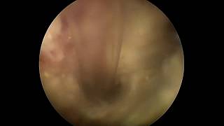 Fimbriated&necrotic bladder TCC/Переходно-клеточная карцинома мочевого пузыря и уретры у собаки Fimbriated&necrotic bladder TCC/Переходно-клеточная карцинома мочевого пузыря и уретры у собаки