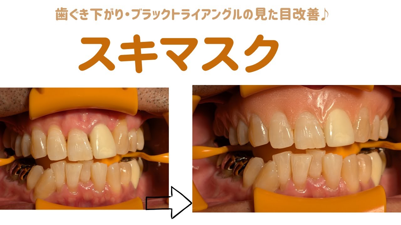 歯ぐき下がり・歯ぐきのスキマにスキマスク♪Gap-Mask for your gums.