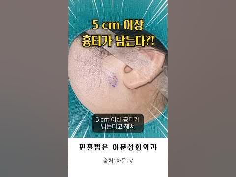 흉터가 5Cm 남는다고? (얼굴 핀홀법 피지낭종 표피낭종 수술 피부과 성형외과 병원 흉터 Epidermal Cyst ...