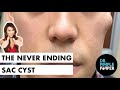 The Never Ending Sac Cyst