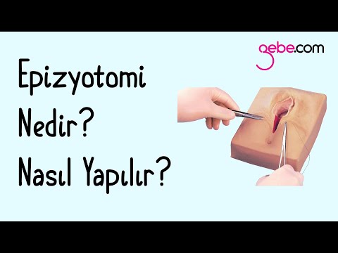 Epizyotomi (Doğum Kesisi)  Nedir, Nasıl Yapılır?