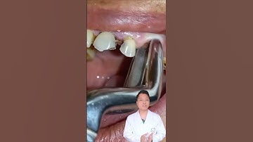 Chiếc răng bị mất thân răng sẽ nhưu thế nào |Dr Cường Offical #drcuong #shorts