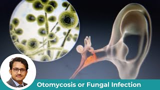 Otomycosis (Fungal Ear Infection): Causes, Symptoms & Treatment Explained