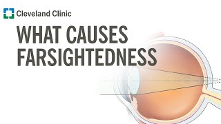 What Causes Farsightedness?