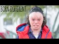 My Skin Condition Made Children Run Away | BORN DIFFERENT