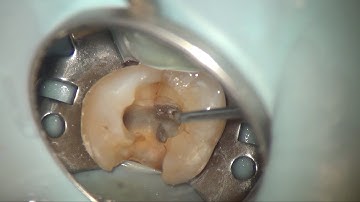 미세현미경 근관치료 (치아신경치료) - 한번에 끝내는 균열치아의 신경치료