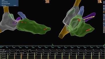 Zero Fluoroscopy Pacemaker Implantation : Possible - Including HIS Bundle Pacing, AICD.