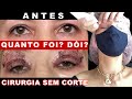 BLEFAROPLASTIA SEM CORTE, JATO DE PLASMA, quanto custa? Dói?