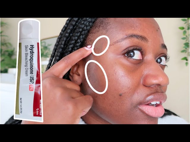 CAN HYDROQUINONE FADE HYPERPIGMENTATION?  | 3 MONTHS USING 4% HYDROQUINONE  - YouTube