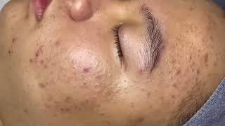 ACNE TREATMENT VU QUYNH MI | Acne Squeeze On Teen Boy 2024[FULL]