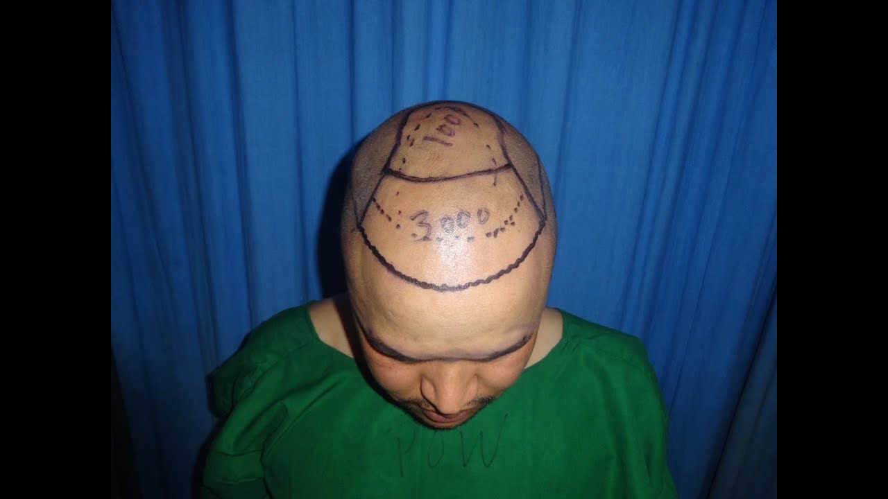 First Hair Transplant in Nepal at Aavaran in 2015 YouTube