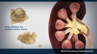 Kidney Stones - South Valley Urology