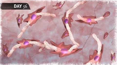 Viveve Treatment Animation