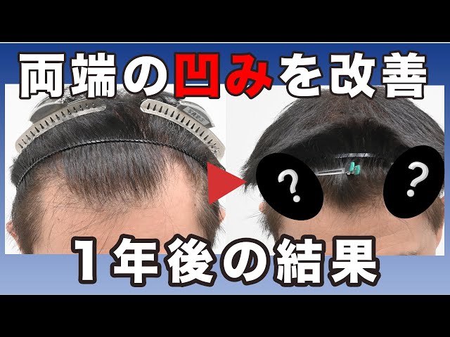 若年性M字ハゲ M字ハゲの基準や対策とは？生え際が後退する原因と治療方法について