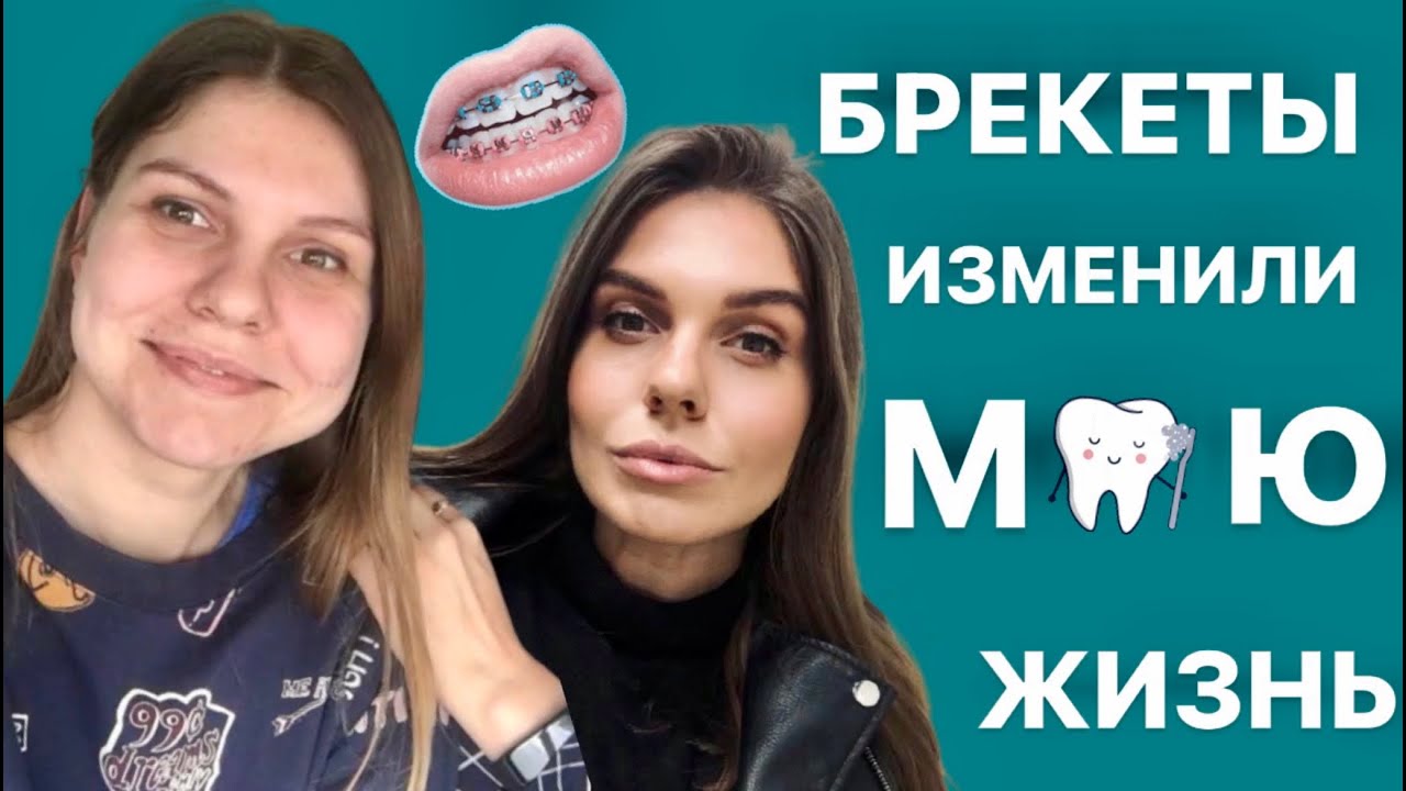 ЗАЧЕМ я МЕЧТАЛА о БРЕКЕТАХ ? | ИСПРАВЛЕНИЕ ПРИКУСА. Как ортодонтия изменила мою жизнь?