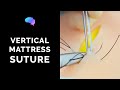 Vertical Mattress Suture - OSCE Guide