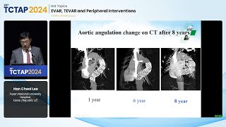 [TCTAP 2024] Hot Topics  EVAR, TEVAR and Peripheral Interventions