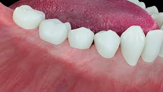 Peri-implant Probing Measurement in Health and Disease with subtitles