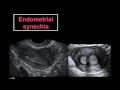 Ultrasound Based Complete Evaluation of the Infertile Patient in a Single Visit