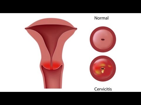 Video: Trichomoniasis Tedavisinin 3 Yolu