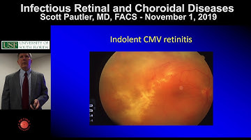 Infectious Retinal and Choroidal Inflammatory Diseases