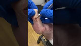 Down Under Foot Care! Dive Into This Amazing Big Toe Callus Removal By Our Aussie Podiatrist. #Footc