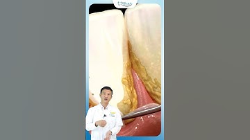 Lấy Cao Răng Đúng Cách Để Không Bị Rụng Răng Khi Già | Bác Sĩ Yên #vuvanyen