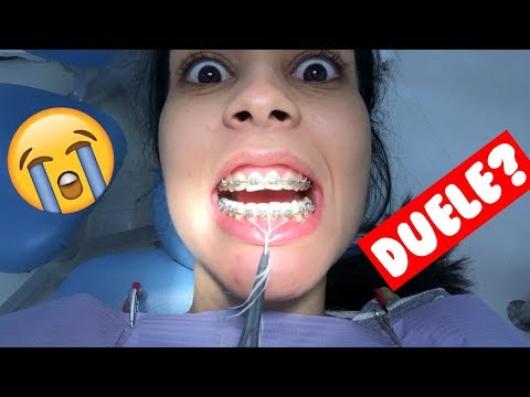 ¡me-quitan-los-brackets!-😨-+-preguntas-&-respuestas