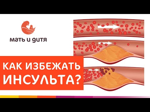 🧠 Лечение атеросклероза сонной артерии стентированием. Атеросклероз сонной артерии. MD GROUP. 18+