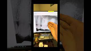 Does the extent of obturation affect the outcome of endodontics? #dentists #rootcanaltherapy