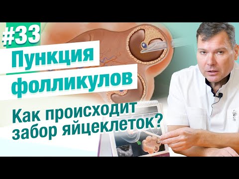 Пункция фолликулов Как происходит забор яйцеклеток при ЭКО? Сколько времени занимает процедура?