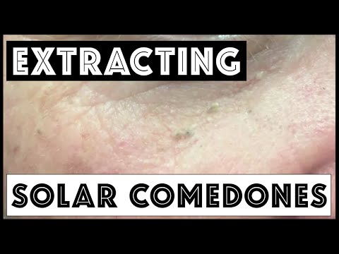 Extracting Solar Comedones And Blackheads In Forehead Creases. For Medical Education- NSFE.