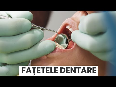 Fatetele dentare, intre avantaje si dezavantaje - Dr Fondrea