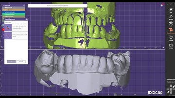 design 3unit bridge  and modified bite alignment by exocad