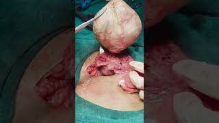 Abdominal myomectomy for a big fundal subserosal Fibroid