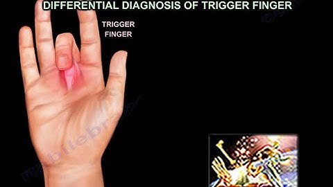 Differential Diagnosis of Trigger Finger - Everything You Need To Know - Dr. Nabil Ebraheim