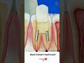 Root Canal Treatment Procedure ↪ 3D Medical Animation #Shorts #RootCanal #Tooth