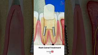 Root Canal Treatment Procedure ↪ 3D Medical Animation #Shorts #RootCanal #Tooth