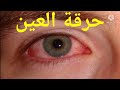 حرارة العيون الأسباب التشخيص والعلاج