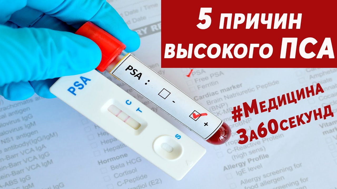 Как правильно сдать пса мужчине подготовка. Исследование крови на пса что это такое. Пса урология. Тест крови на пса. Пса крови у мужчин.