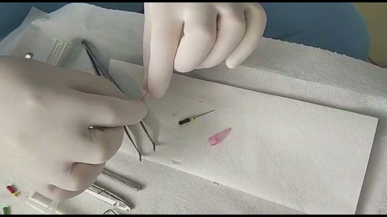 Alt premolar dişte güta-perkalı kanal dolumu